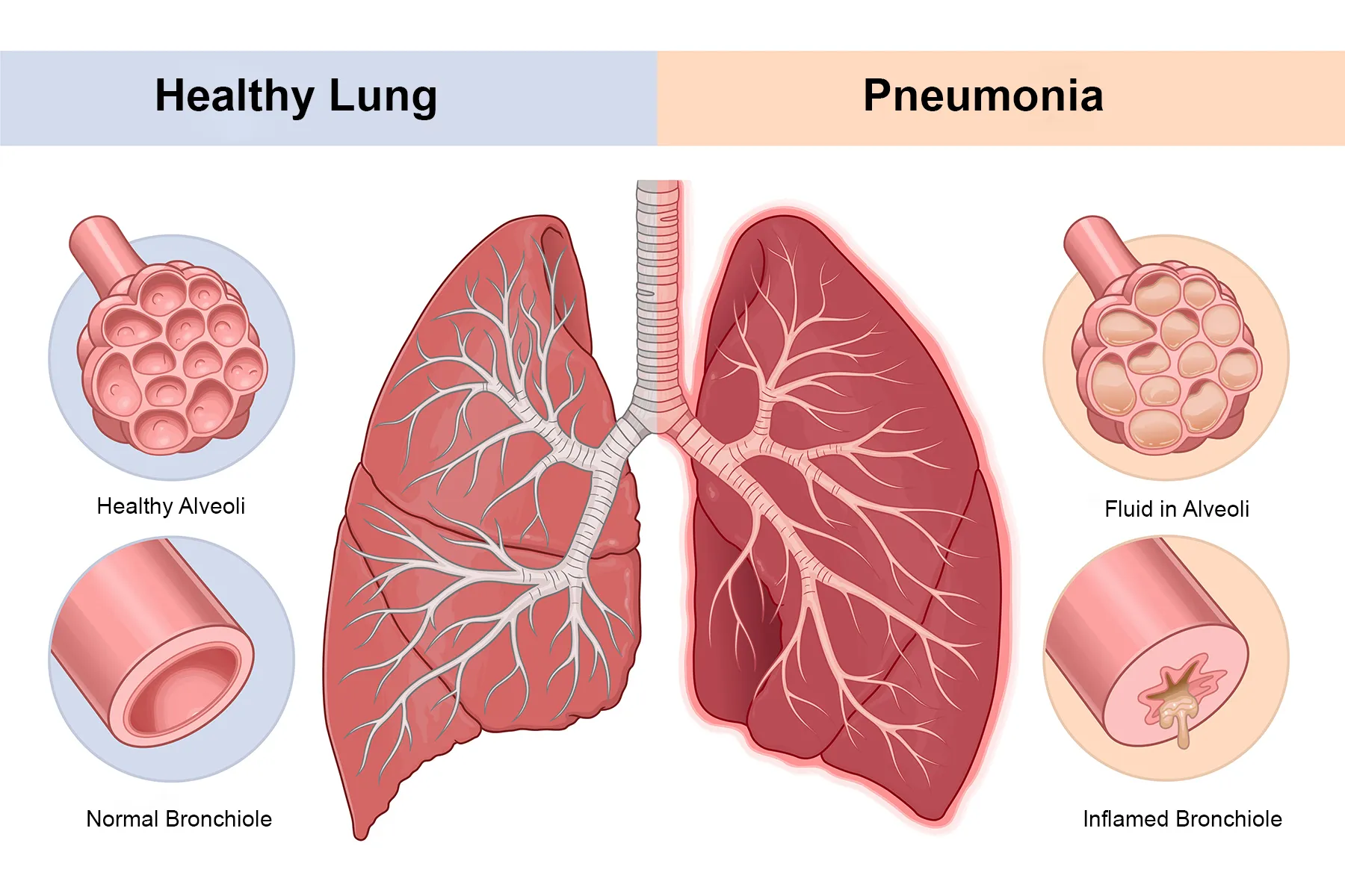 Post-Pneumonia Rehab
