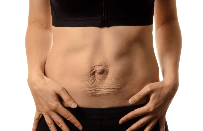 Diastasis Recti